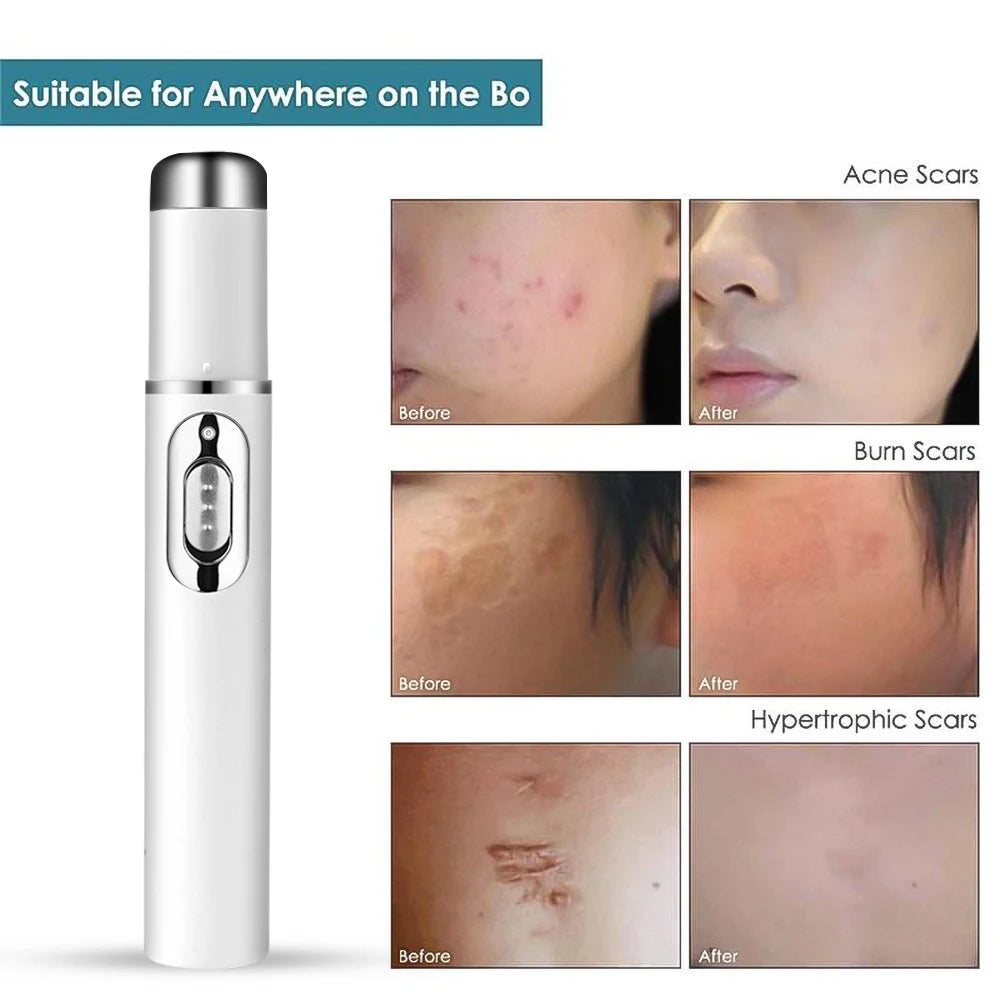 Acne/wrinkle removal Laser Pen